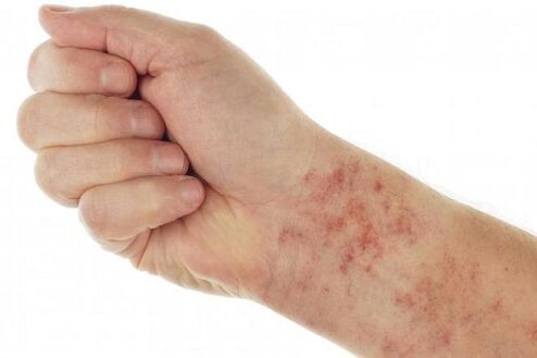 Allergies due to internal parasites