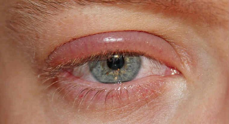 Demodex eyelids