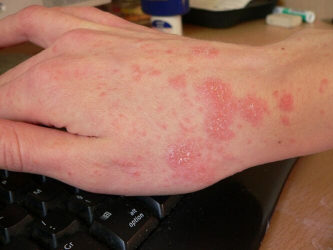 Human hands affected by scabies